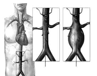 腹主(zhu)動(dòng)脈瘤